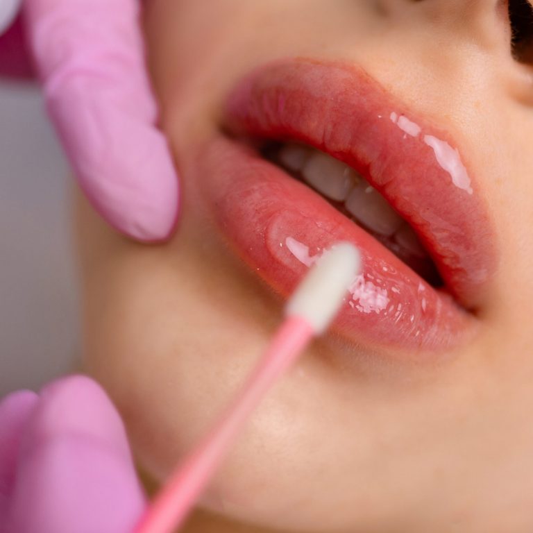 Lip Injection, Lip fillers